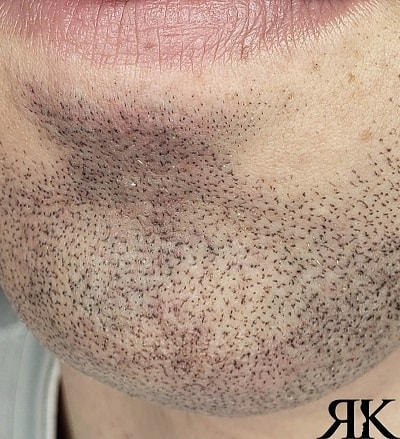 Facial-Micropigmentation-After-2