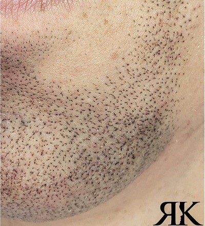 Facial-Micropigmentation-After-3