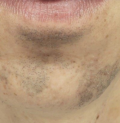 Facial-Micropigmentation-Before-2