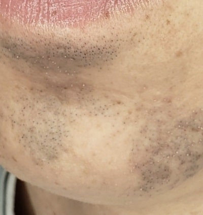 Facial-Micropigmentation-Before-3