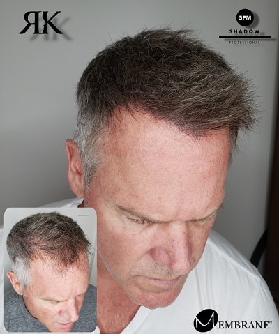 Hair Density | Ryan Kingsbury | Scalp Micropigmentation