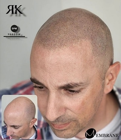 Best-Scalp-Micropigmentation-Canada-01-1