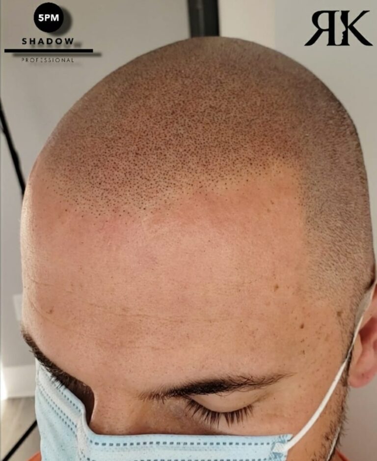 Best-Scalp-Micropigmentation-Canada-034