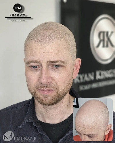 Is Scalp Micropigmentation a Tattoo  Scalp Micro UK