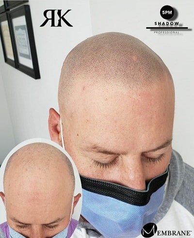 Best-Scalp-Micropigmentation-Canada-2-1