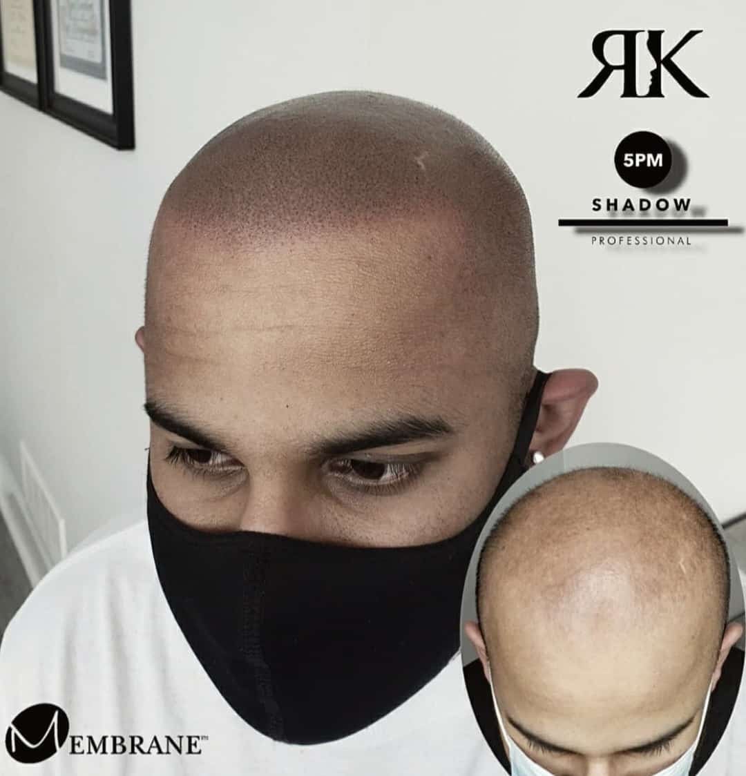 Best-Scalp-Micropigmentation-Canada-34