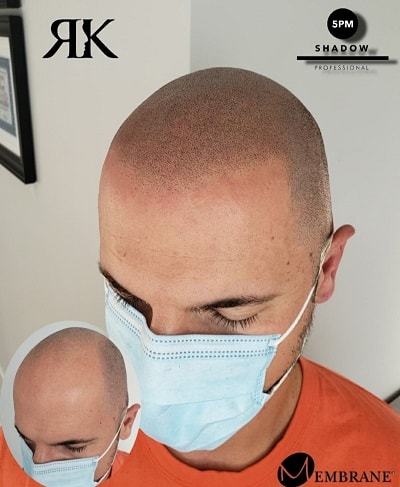 Best-Scalp-Micropigmentation-Canada-90-1