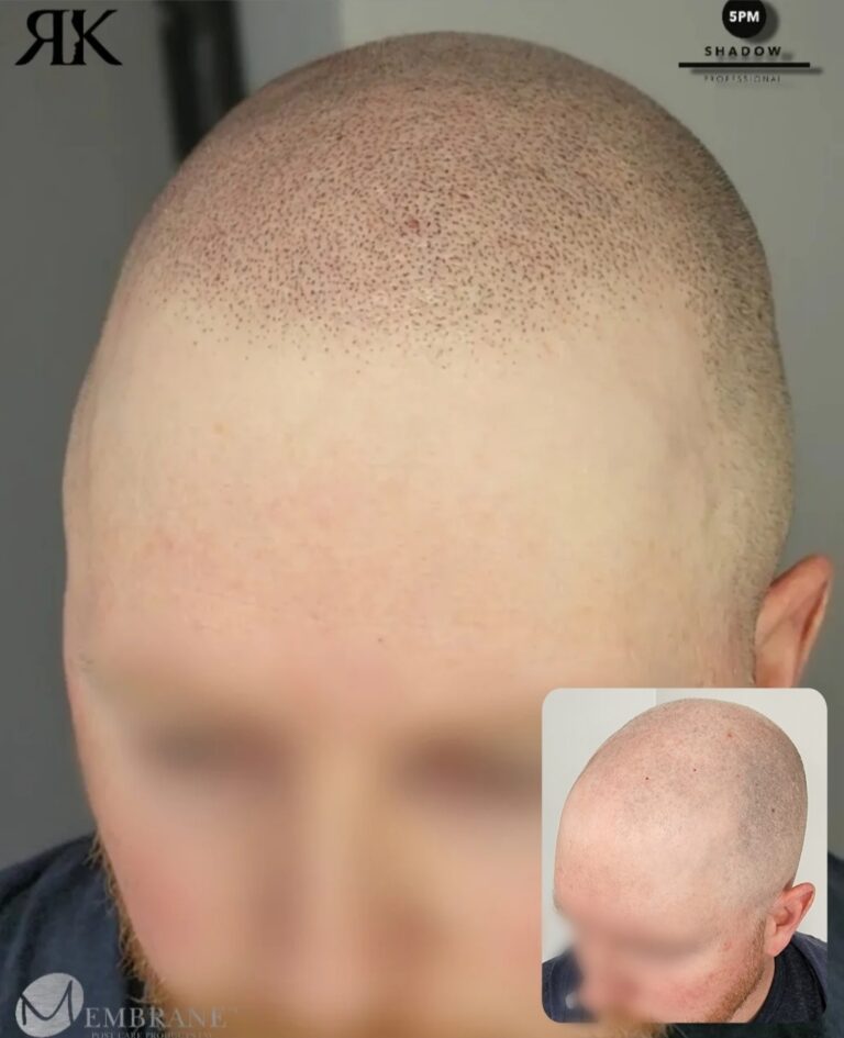 Best-Scalp-Micropigmentation-Canada-963