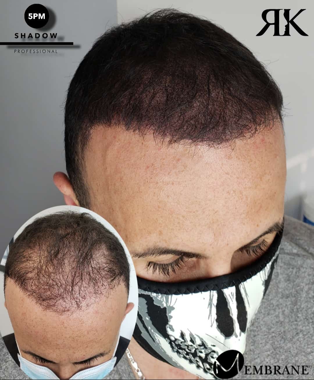 Scalp-Micropigmentation-Hair-Density-068