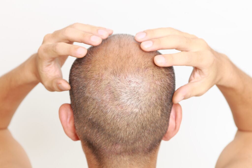 Scalp Micropigmentation with Hair Treatment in India  Redefine