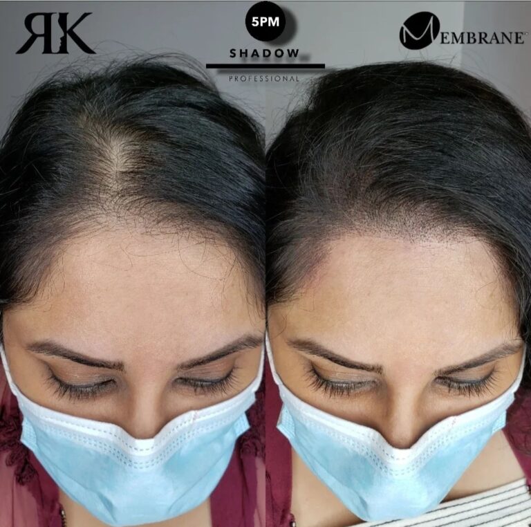 Scalp-Micropigmentation-Women-Canada-Best-234 (1)
