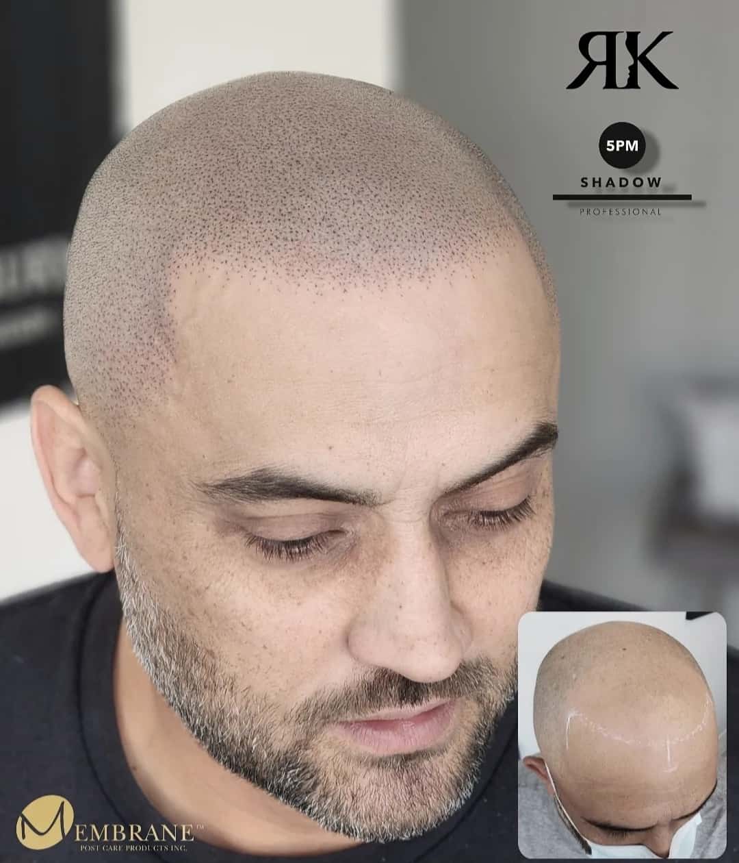 Best-Scalp-Micropigmentation-Canada-2