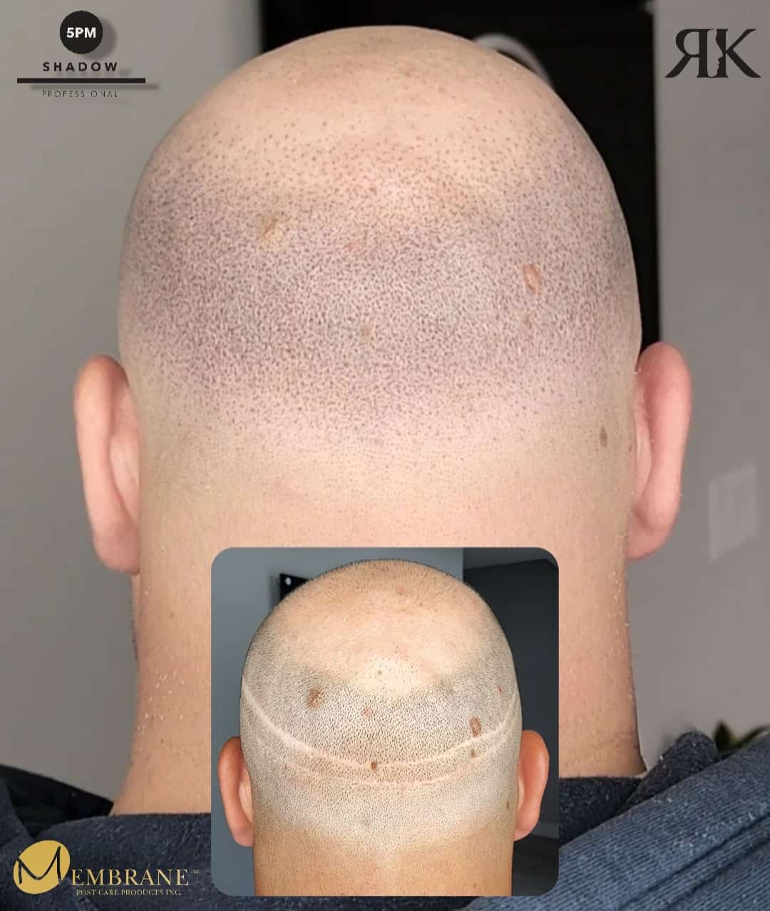 Best-Scalp-Micropigmentation-Canada-03