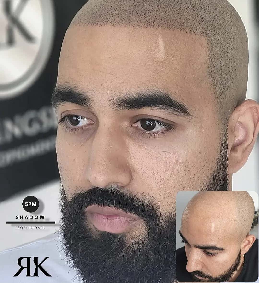 Best-Scalp-Micropigmentation-Canada-109