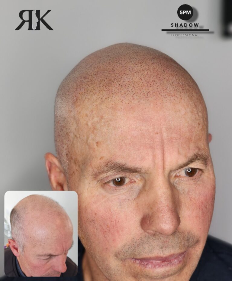 Best-Scalp-Micropigmentation-Canada-08423