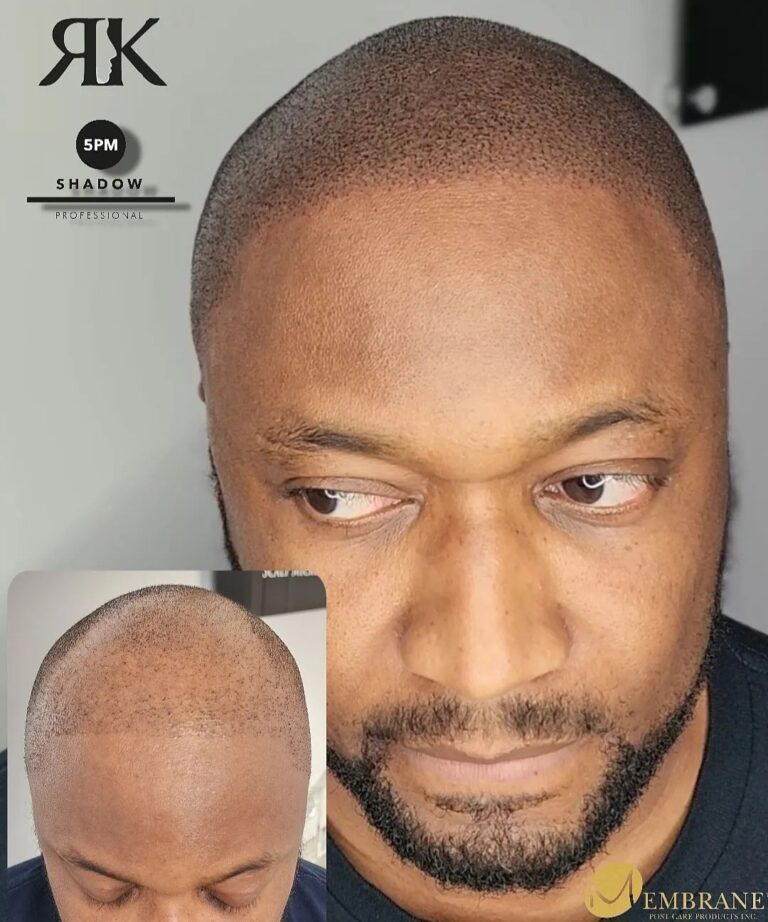 Best-Scalp-Micropigmentation-Canada-2731