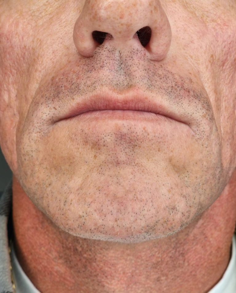 Best-Facial-Micropigmentation-Canada-10