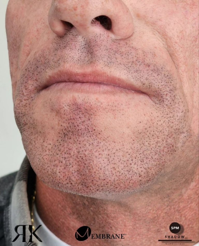 Best-Facial-Micropigmentation-Canada-9