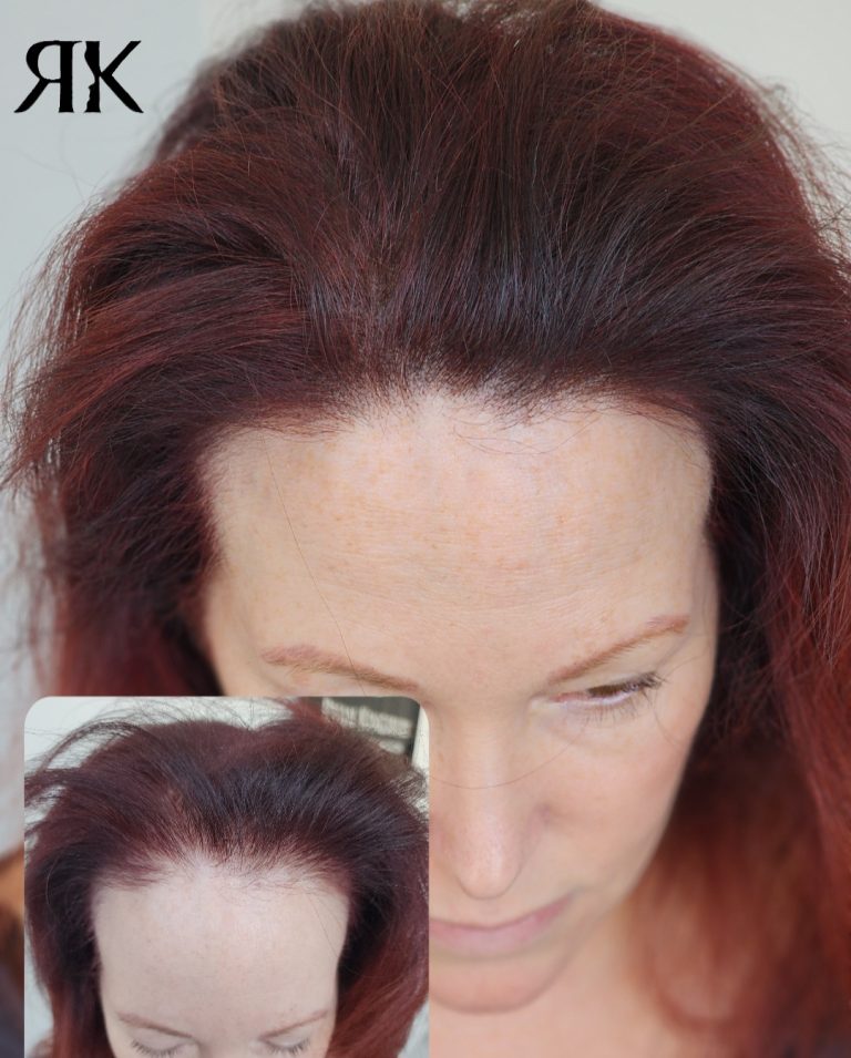 Best-Female-Hair-Density-Canada-1