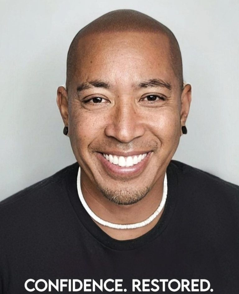 Best-Scalp-Micropigmentation-Canada-000 (1)