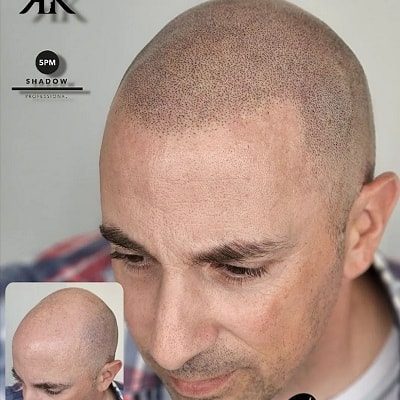 Best-Scalp-Micropigmentation-Canada-01-1