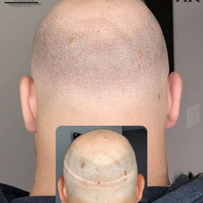 Best-Scalp-Micropigmentation-Canada-03