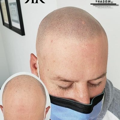 Best-Scalp-Micropigmentation-Canada-2-1