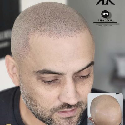 Best-Scalp-Micropigmentation-Canada-2