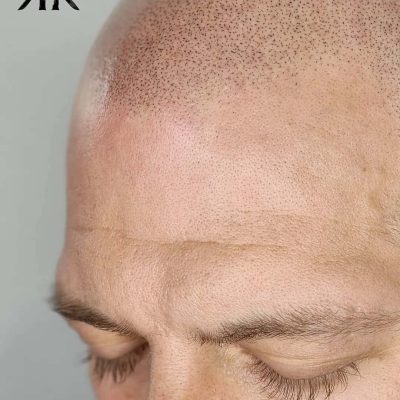 Best-Scalp-Micropigmentation-Canada-270