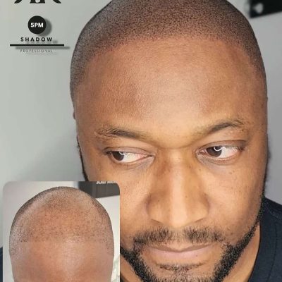 Best-Scalp-Micropigmentation-Canada-2731