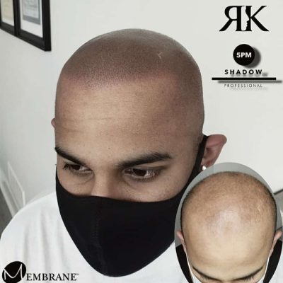 Best-Scalp-Micropigmentation-Canada-34