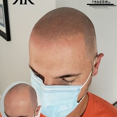 Best-Scalp-Micropigmentation-Canada-90-1