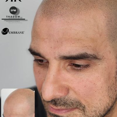 Best-Scalp-Micropigmentation-Canada-980