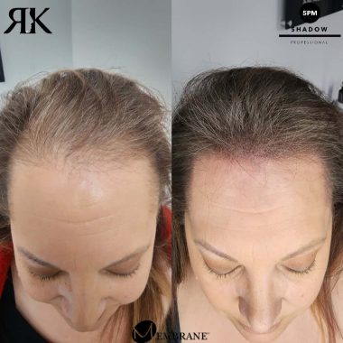 Best-Scalp-Micropigmentation-Canada-Women-03