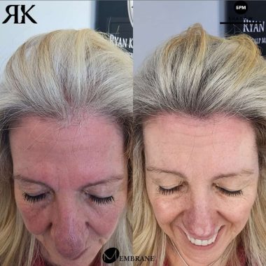 Best-Scalp-Micropigmentation-Canada-Women-08423