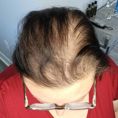 Best-Scalp-Micropigmentation-Women-785