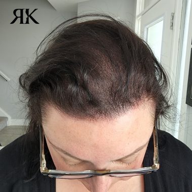 Best-Scalp-Micropigmentation-Women-After-21
