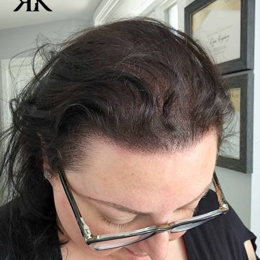 Best-Scalp-Micropigmentation-Women-After-85