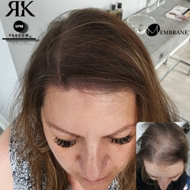 Best-Scalp-Micropigmentation-Women