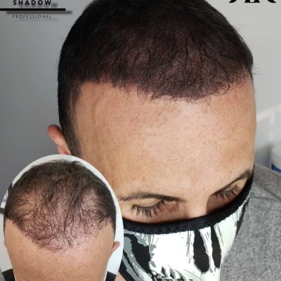 Scalp-Micropigmentation-Hair-Density-068