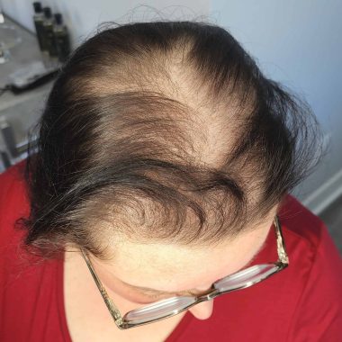 Scalp-Micropigmentation-Women-22